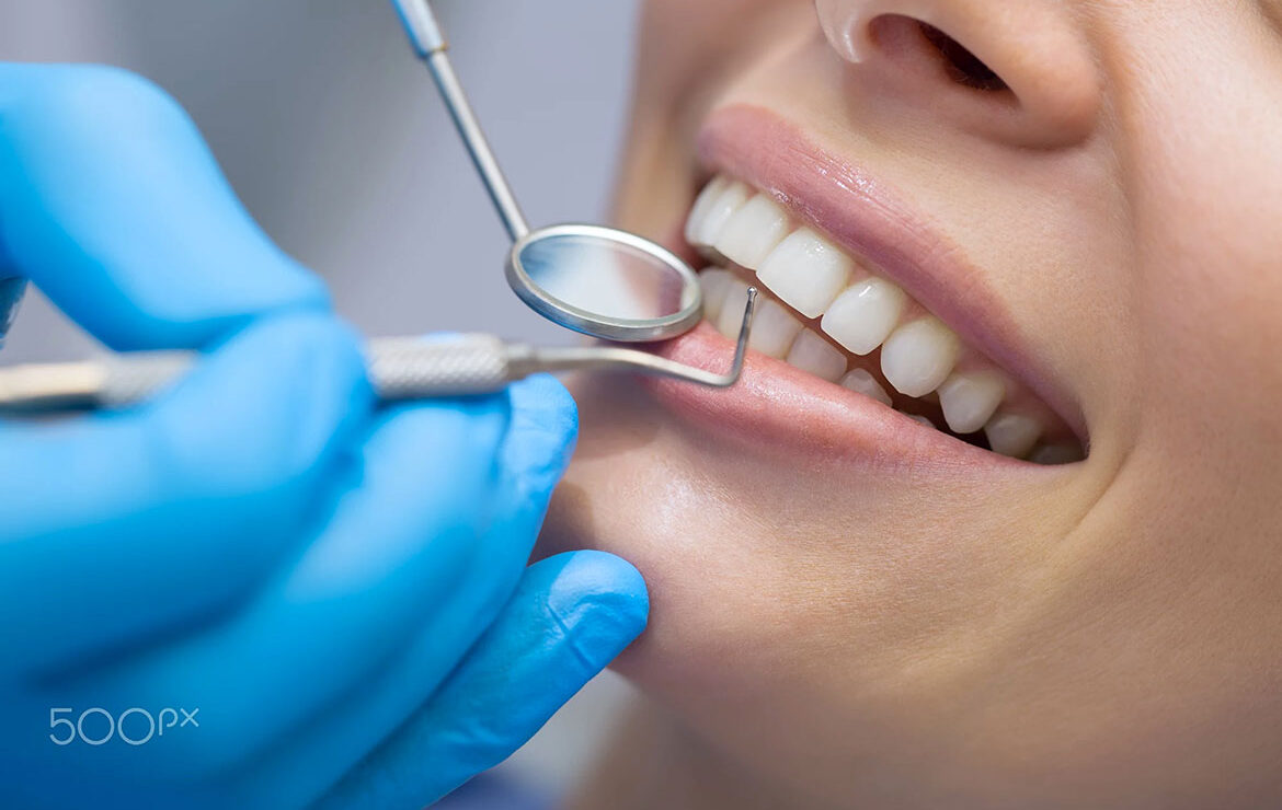 How Long Do Veneers Last And How to Care for Them