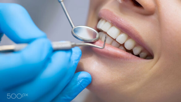 How Long Do Veneers Last And How to Care for Them