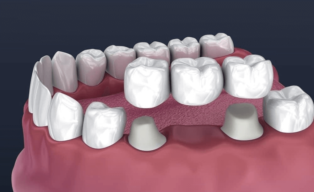 dental bridges berwick