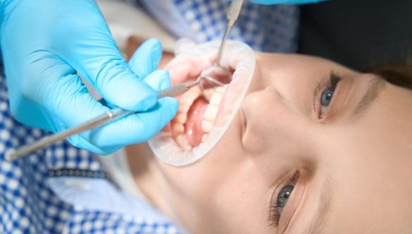 What Is a Composite Build-Up?