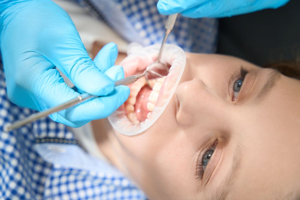 What Is a Composite Build-Up?